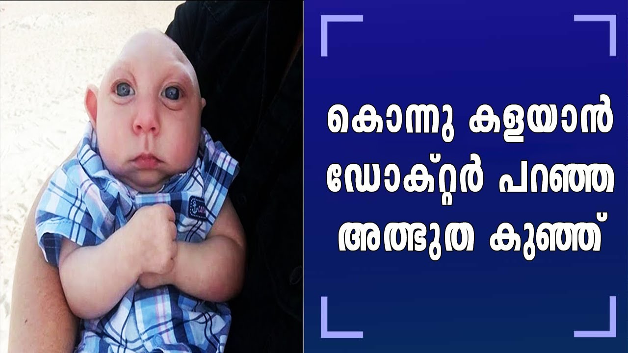 വൈദ്യശാസ്ത്രത്തിന് ഇന്നും അത്ഭുതമാണ് തലച്ചോർ ഇല്ലാതെ ജനിച്ച ഈ കുഞ്ഞ്