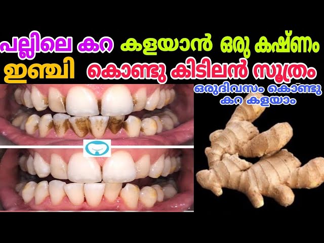 പല്ലുകളിൽ ഉണ്ടാകുന്ന മഞ്ഞക്കറകൾ ഈസിയായി റിമൂവ് ചെയ്യാം..