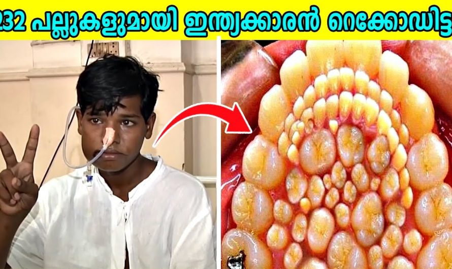 വായിൽ നിറയെ പല്ലുകളുമായി ജനിച്ച ഒരു വിചിത്ര മനുഷ്യൻ..