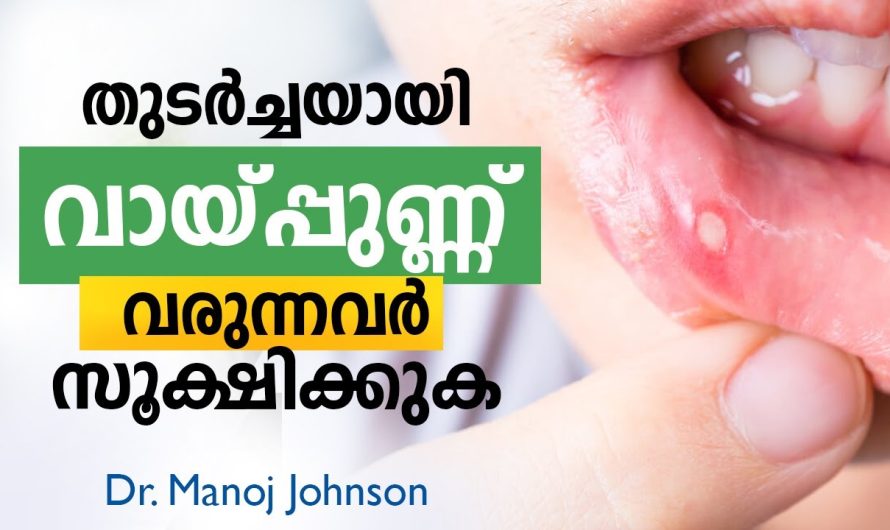 ഇടയ്ക്കിടയ്ക്ക് മൗത്ത് അൾസർ വരുന്ന വ്യക്തിയാണെങ്കിൽ ഈ വീഡിയോ കാണാതെ പോകരുത്..
