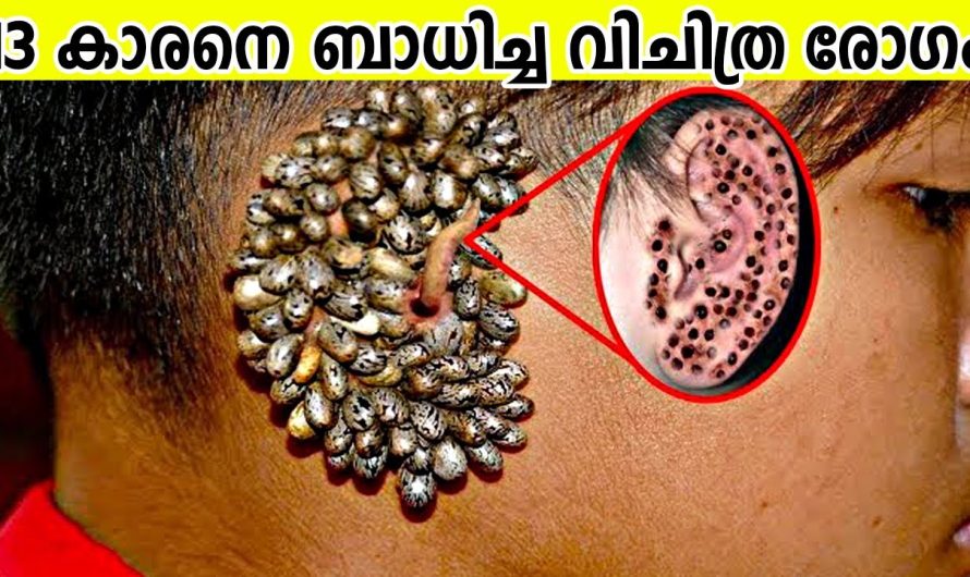 വിചിത്രമായ ജനിതക രോഗങ്ങൾ ബാധിച്ച ലോകത്തിലെ മനുഷ്യർ..